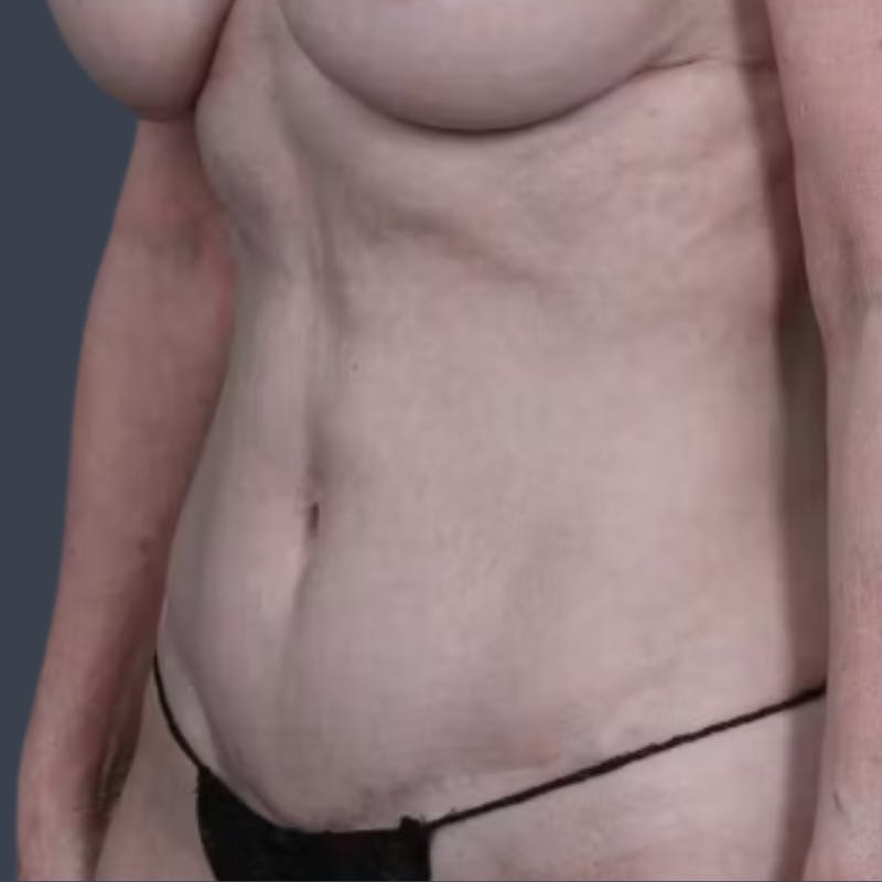 Abdominoplasty / Tummy Tuck Before & After Gallery - Patient 354150 - Image 4