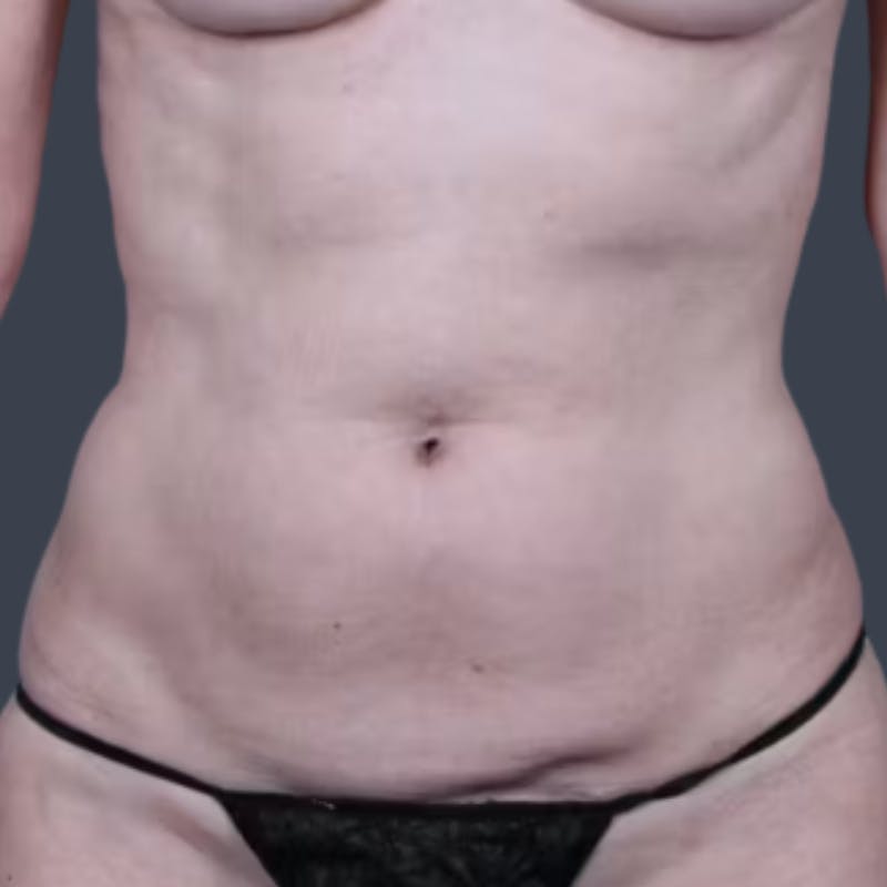 Abdominoplasty / Tummy Tuck Before & After Gallery - Patient 354150 - Image 2