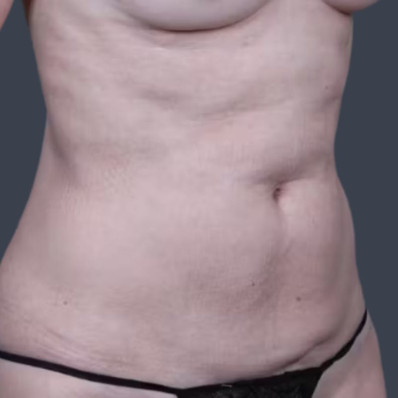 Abdominoplasty / Tummy Tuck Before & After Gallery - Patient 354150 - Image 5