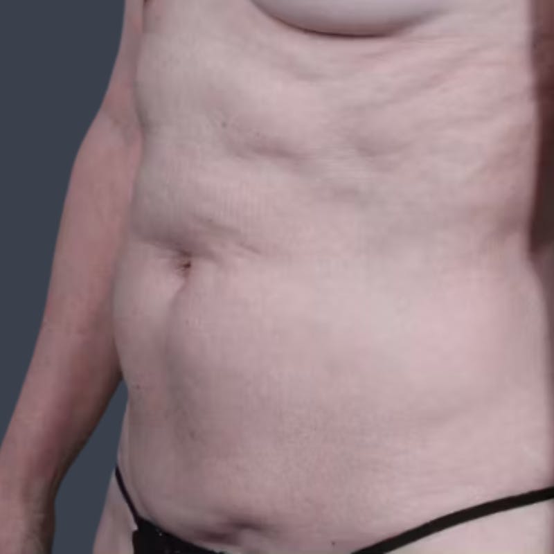 Abdominoplasty / Tummy Tuck Before & After Gallery - Patient 354150 - Image 3