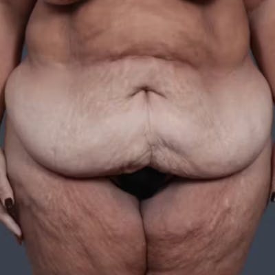 Abdominoplasty / Tummy Tuck Before & After Gallery - Patient 957802 - Image 1