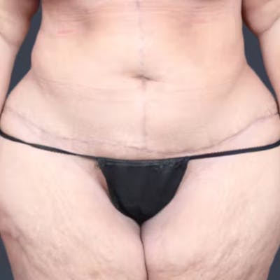 Abdominoplasty / Tummy Tuck Before & After Gallery - Patient 957802 - Image 2