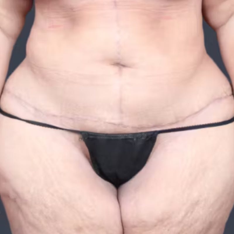 Abdominoplasty / Tummy Tuck Before & After Gallery - Patient 957802 - Image 2