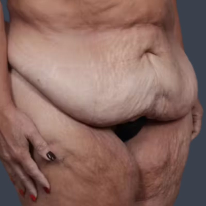 Abdominoplasty / Tummy Tuck Before & After Gallery - Patient 957802 - Image 5
