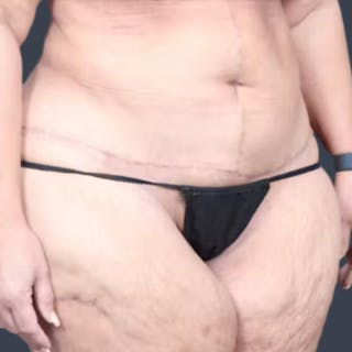 Abdominoplasty / Tummy Tuck Before & After Gallery - Patient 957802 - Image 6