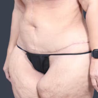 Abdominoplasty / Tummy Tuck Before & After Gallery - Patient 957802 - Image 4