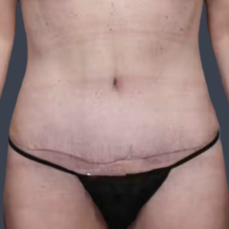 Abdominoplasty / Tummy Tuck Before & After Gallery - Patient 374785 - Image 2