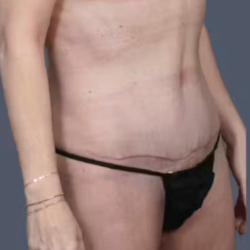 Abdominoplasty / Tummy Tuck Before & After Gallery - Patient 374785 - Image 6