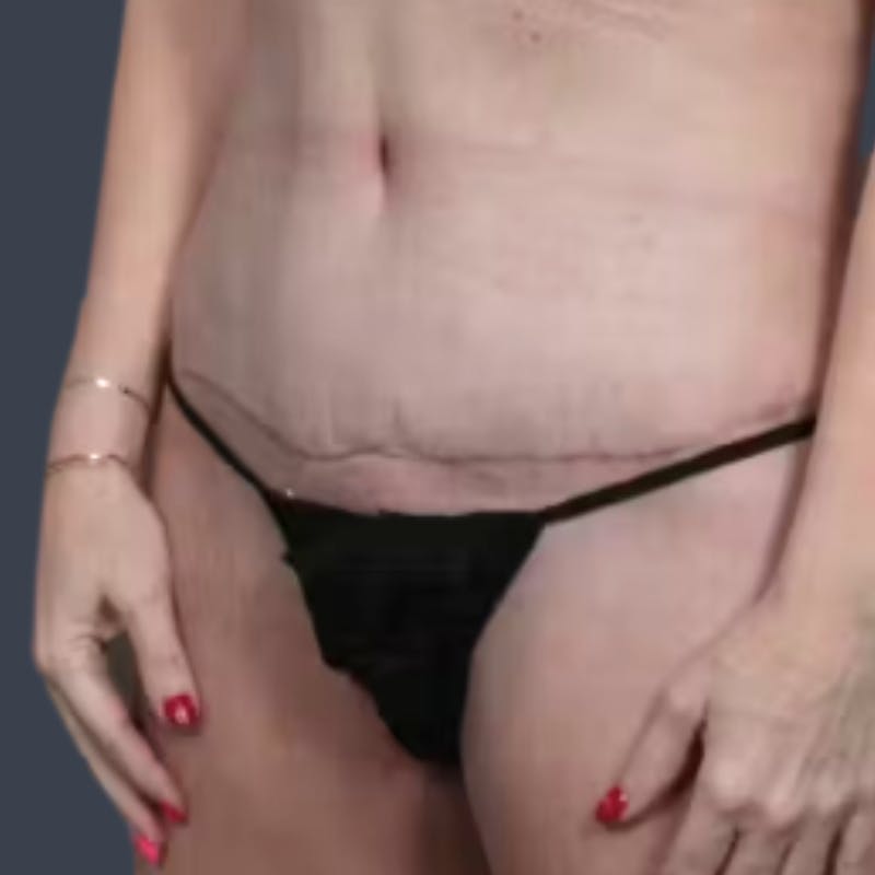Abdominoplasty / Tummy Tuck Before & After Gallery - Patient 374785 - Image 4
