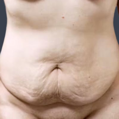 Abdominoplasty / Tummy Tuck Before & After Gallery - Patient 349924 - Image 1
