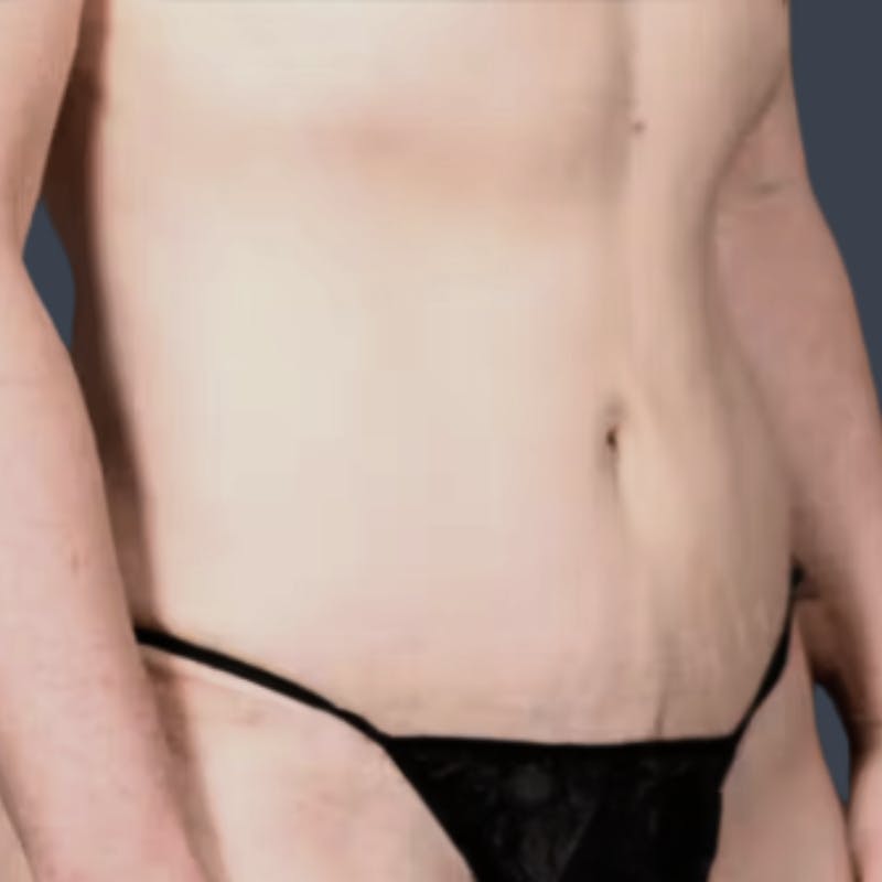 Abdominoplasty / Tummy Tuck Before & After Gallery - Patient 349924 - Image 4