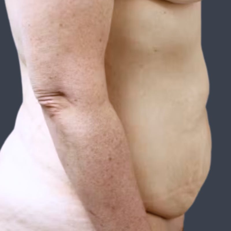 Abdominoplasty / Tummy Tuck Before & After Gallery - Patient 349924 - Image 5