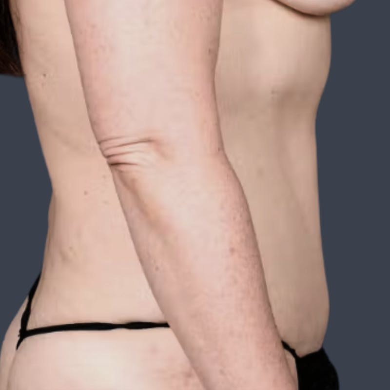 Abdominoplasty / Tummy Tuck Before & After Gallery - Patient 349924 - Image 6