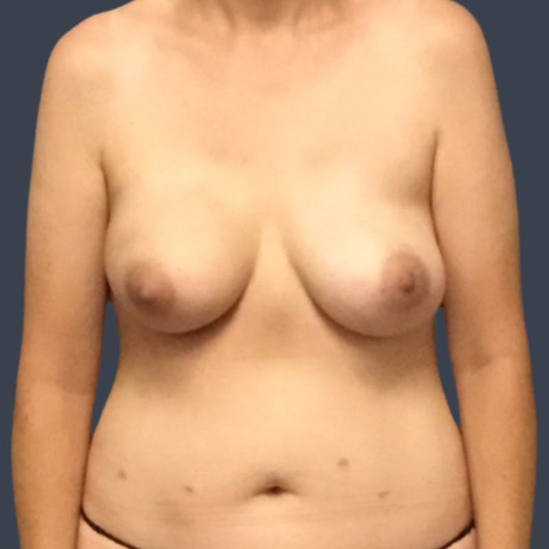 DIEP Flap Before & After Gallery - Patient 420488 - Image 1