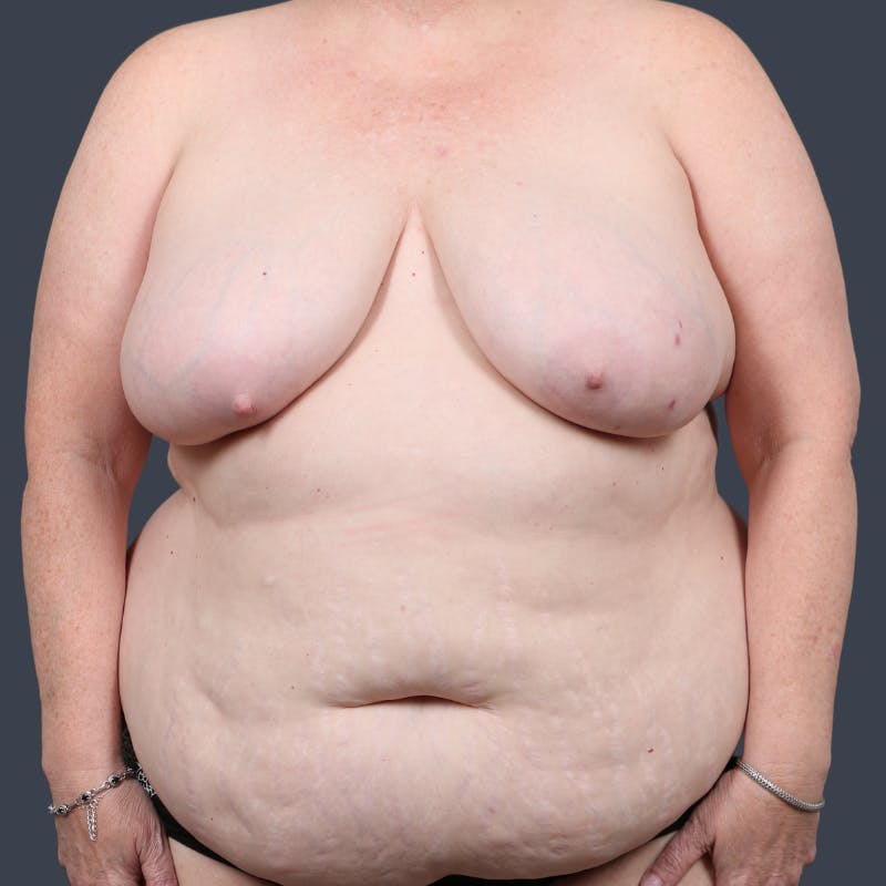 DIEP Flap Before & After Gallery - Patient 232974 - Image 1