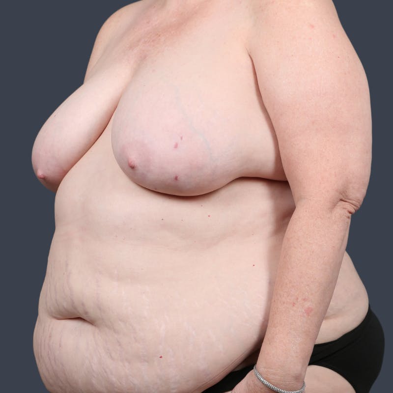 DIEP Flap Before & After Gallery - Patient 232974 - Image 5