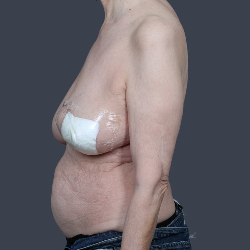DIEP Flap Before & After Gallery - Patient 147458 - Image 5