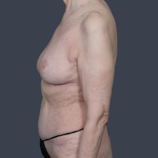 DIEP Flap Before & After Gallery - Patient 147458 - Image 6