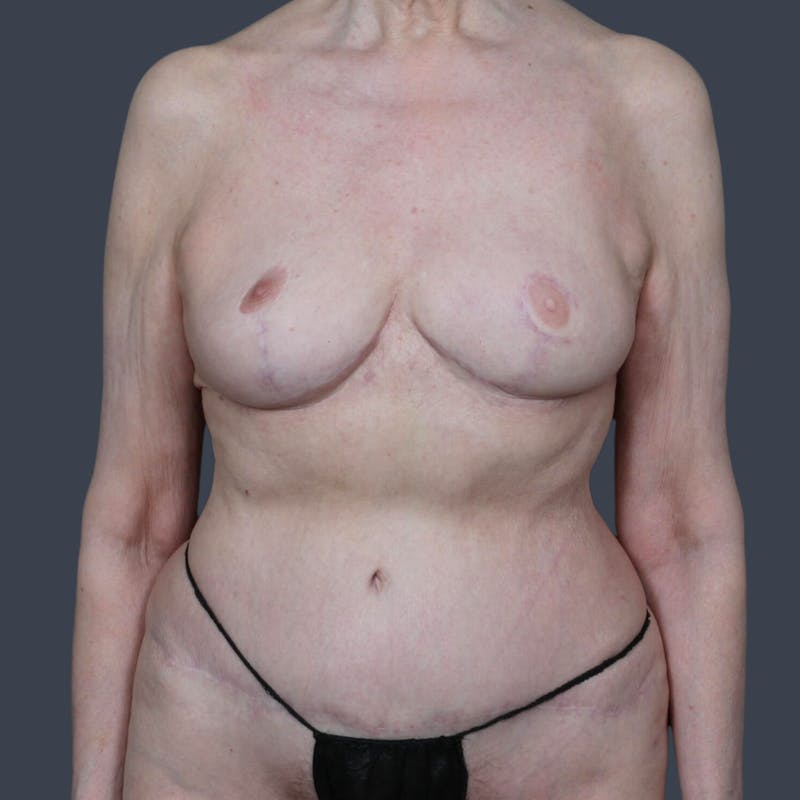 DIEP Flap Before & After Gallery - Patient 147458 - Image 2