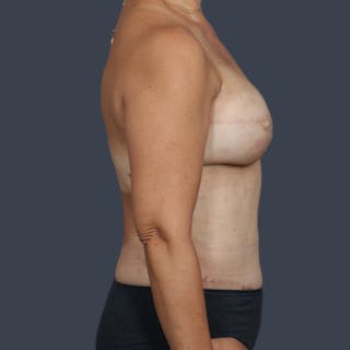DIEP Flap Before & After Gallery - Patient 487094 - Image 6