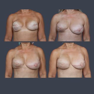 DIEP Flap Before & After Gallery - Patient 487094 - Image 8