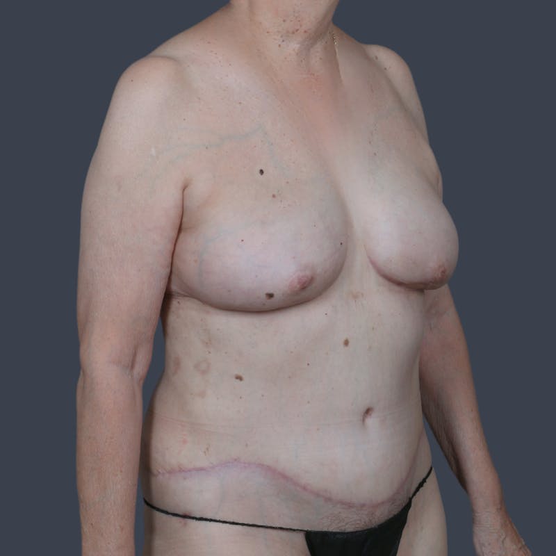 DIEP Flap Before & After Gallery - Patient 112658 - Image 4