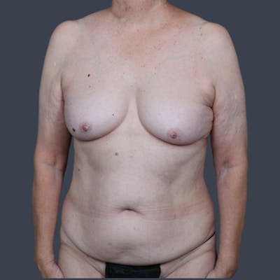 DIEP Flap Before & After Gallery - Patient 112658 - Image 1