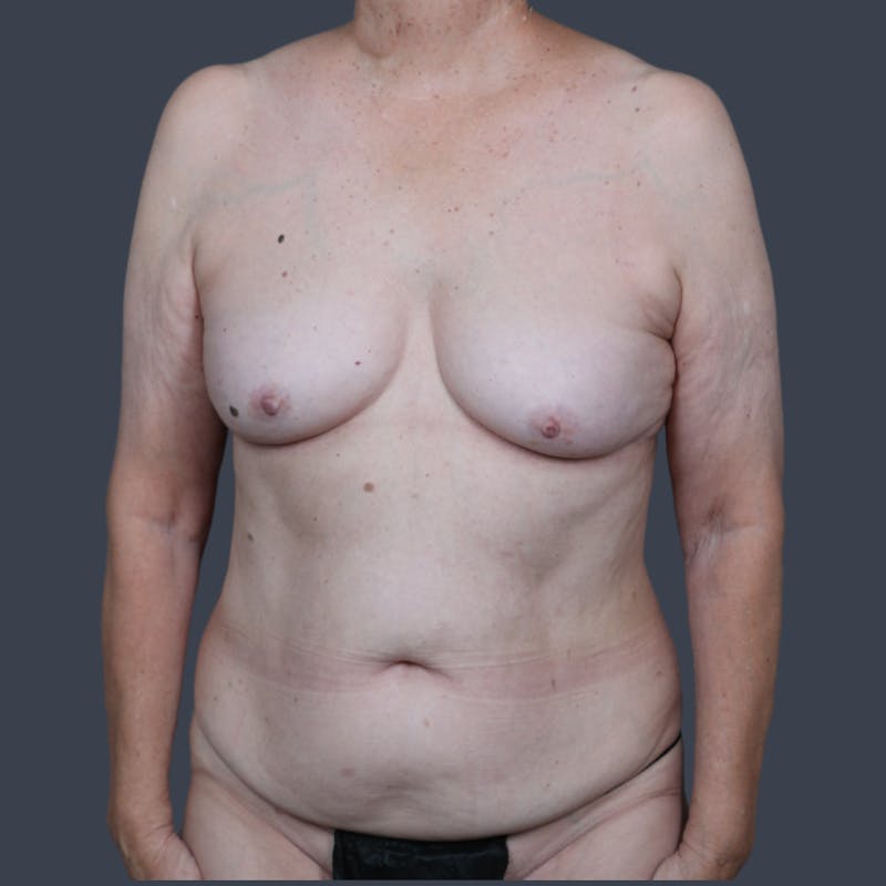 DIEP Flap Before & After Gallery - Patient 112658 - Image 1