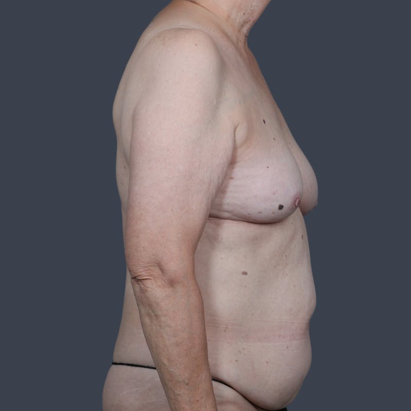 DIEP Flap Before & After Gallery - Patient 112658 - Image 5