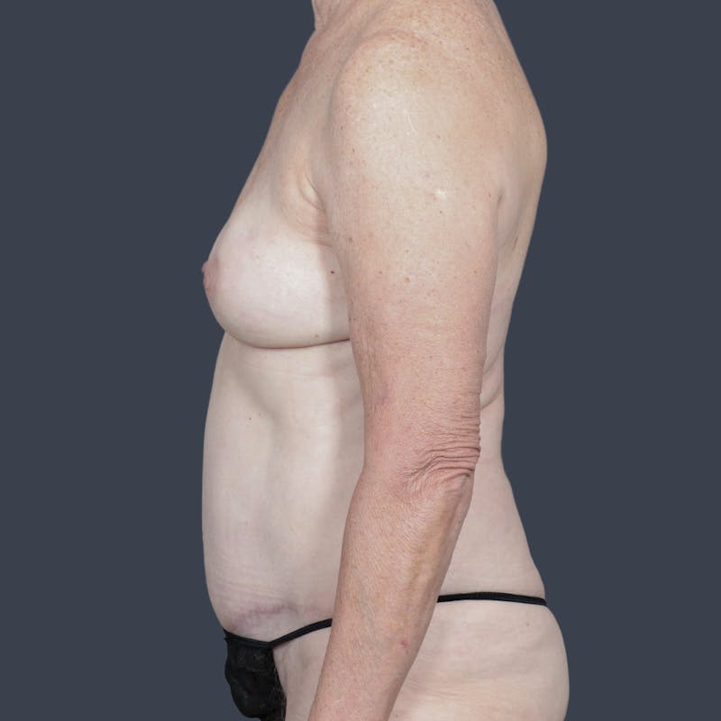 DIEP Flap Before & After Gallery - Patient 123975 - Image 6