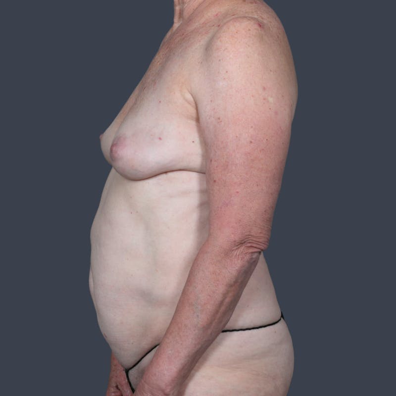 DIEP Flap Before & After Gallery - Patient 123975 - Image 5