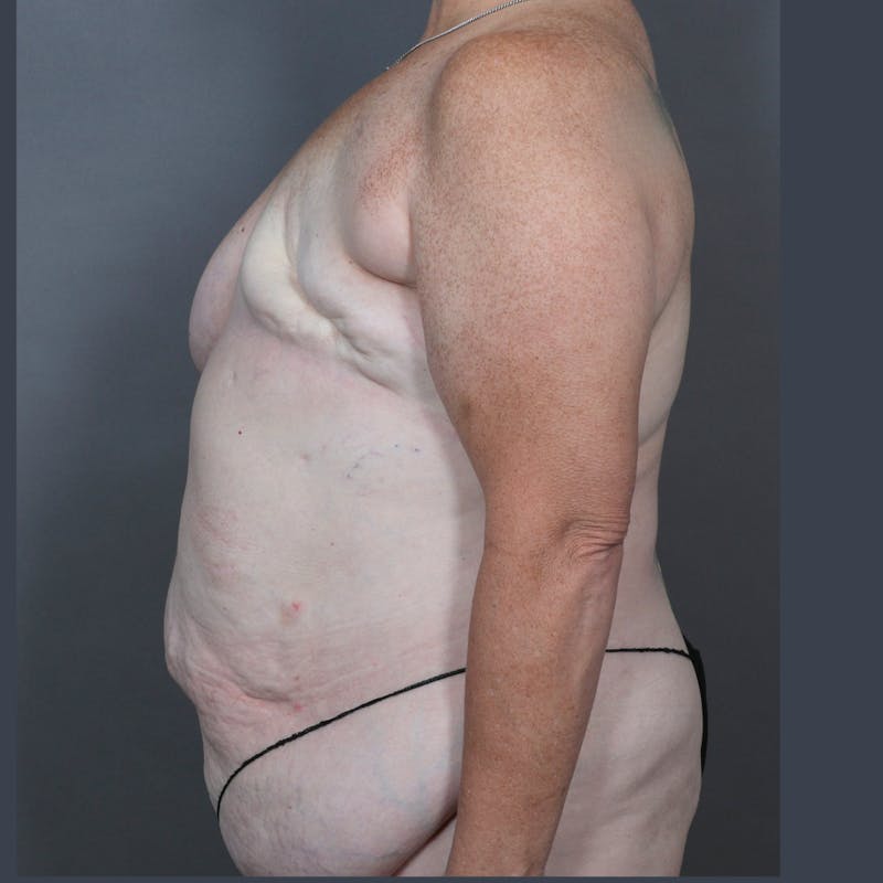 DIEP Flap Before & After Gallery - Patient 897781 - Image 5