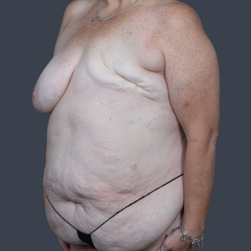 DIEP Flap Before & After Gallery - Patient 897781 - Image 3