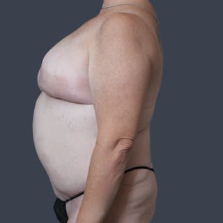 DIEP Flap Before & After Gallery - Patient 897781 - Image 6