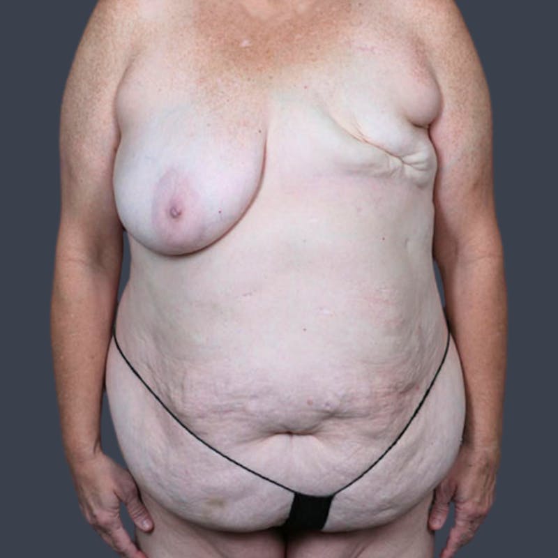 DIEP Flap Before & After Gallery - Patient 897781 - Image 7