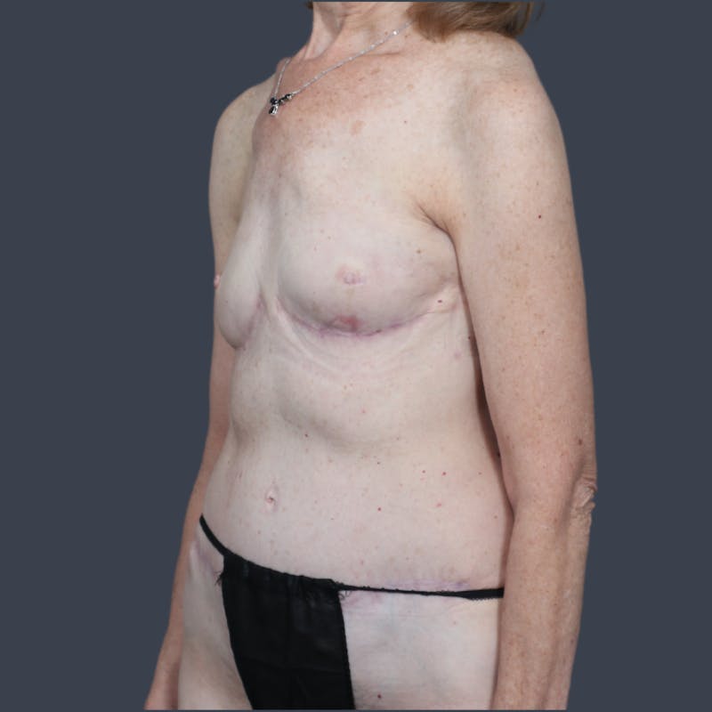 DIEP Flap Before & After Gallery - Patient 404958 - Image 4