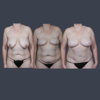 DIEP Flap Before & After Gallery - Patient 405917 - Image 6