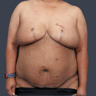 DIEP Flap Before & After Gallery - Patient 405358 - Image 2
