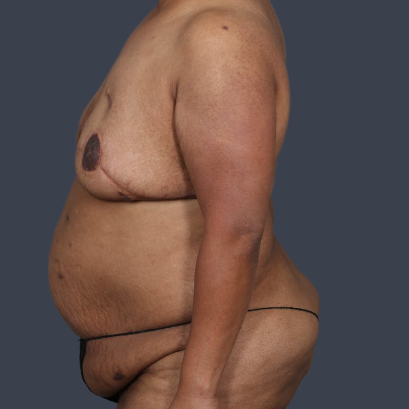 DIEP Flap Before & After Gallery - Patient 405358 - Image 5