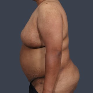 DIEP Flap Before & After Gallery - Patient 405358 - Image 6