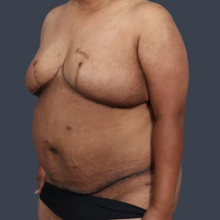 DIEP Flap Before & After Gallery - Patient 405358 - Image 4