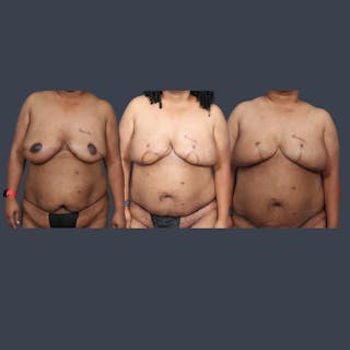 DIEP Flap Before & After Gallery - Patient 405358 - Image 8