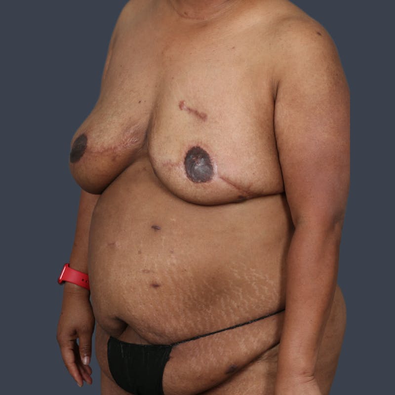 DIEP Flap Before & After Gallery - Patient 405358 - Image 3