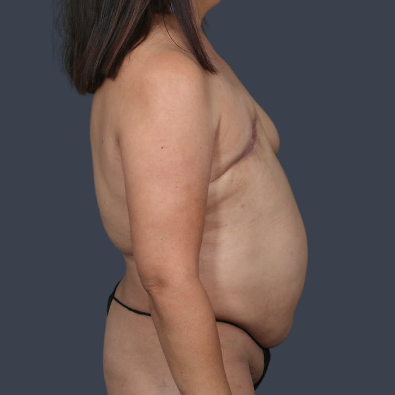 DIEP Flap Before & After Gallery - Patient 140858 - Image 5