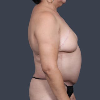 DIEP Flap Before & After Gallery - Patient 140858 - Image 6