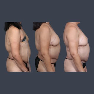 DIEP Flap Before & After Gallery - Patient 140858 - Image 8