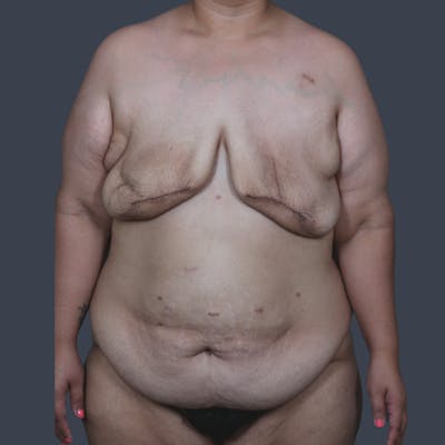 DIEP Flap Before & After Gallery - Patient 646753 - Image 1