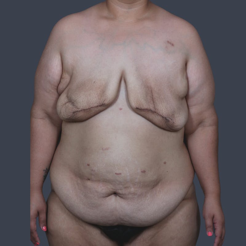 DIEP Flap Before & After Gallery - Patient 646753 - Image 1