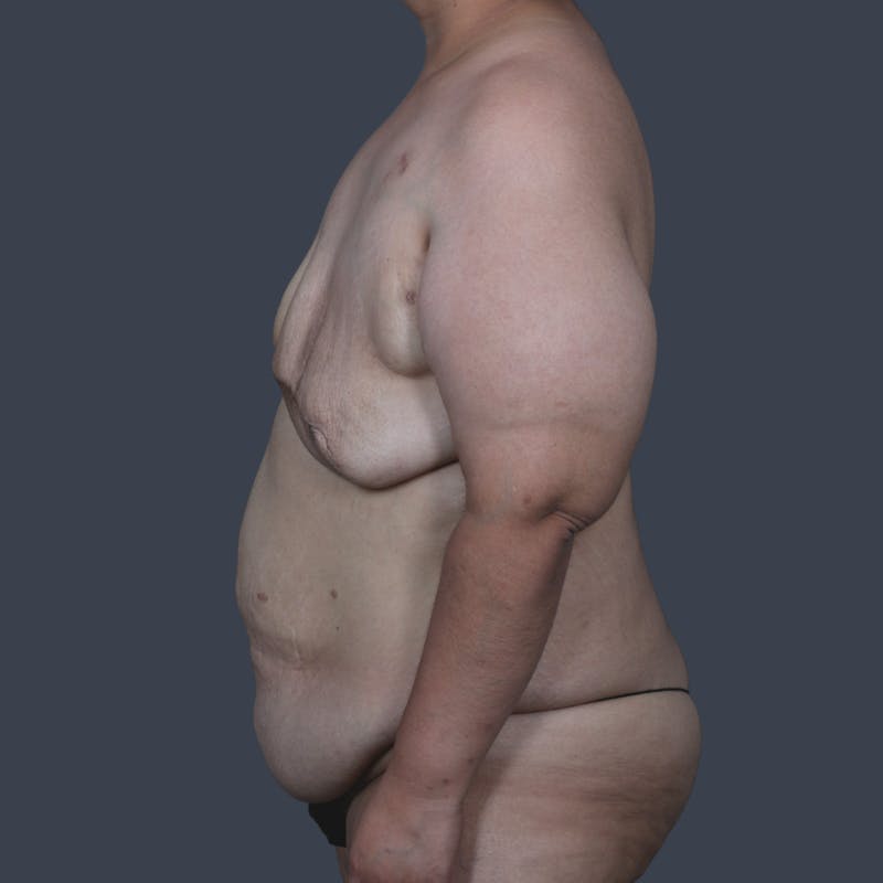 DIEP Flap Before & After Gallery - Patient 646753 - Image 5
