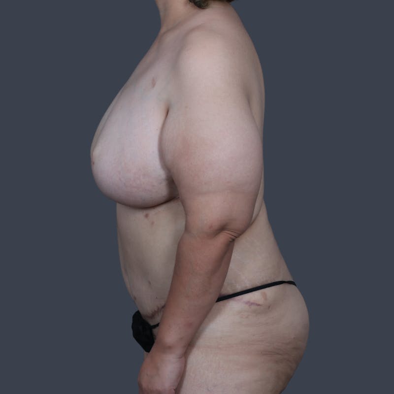 DIEP Flap Before & After Gallery - Patient 646753 - Image 6